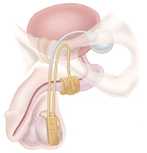 Artificial Urinary Sphincter Andrew Neeb MD
